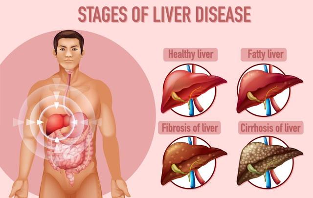 tahapan hepatitis